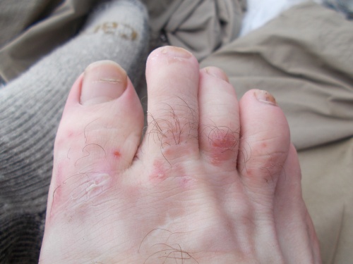 Foot troubles